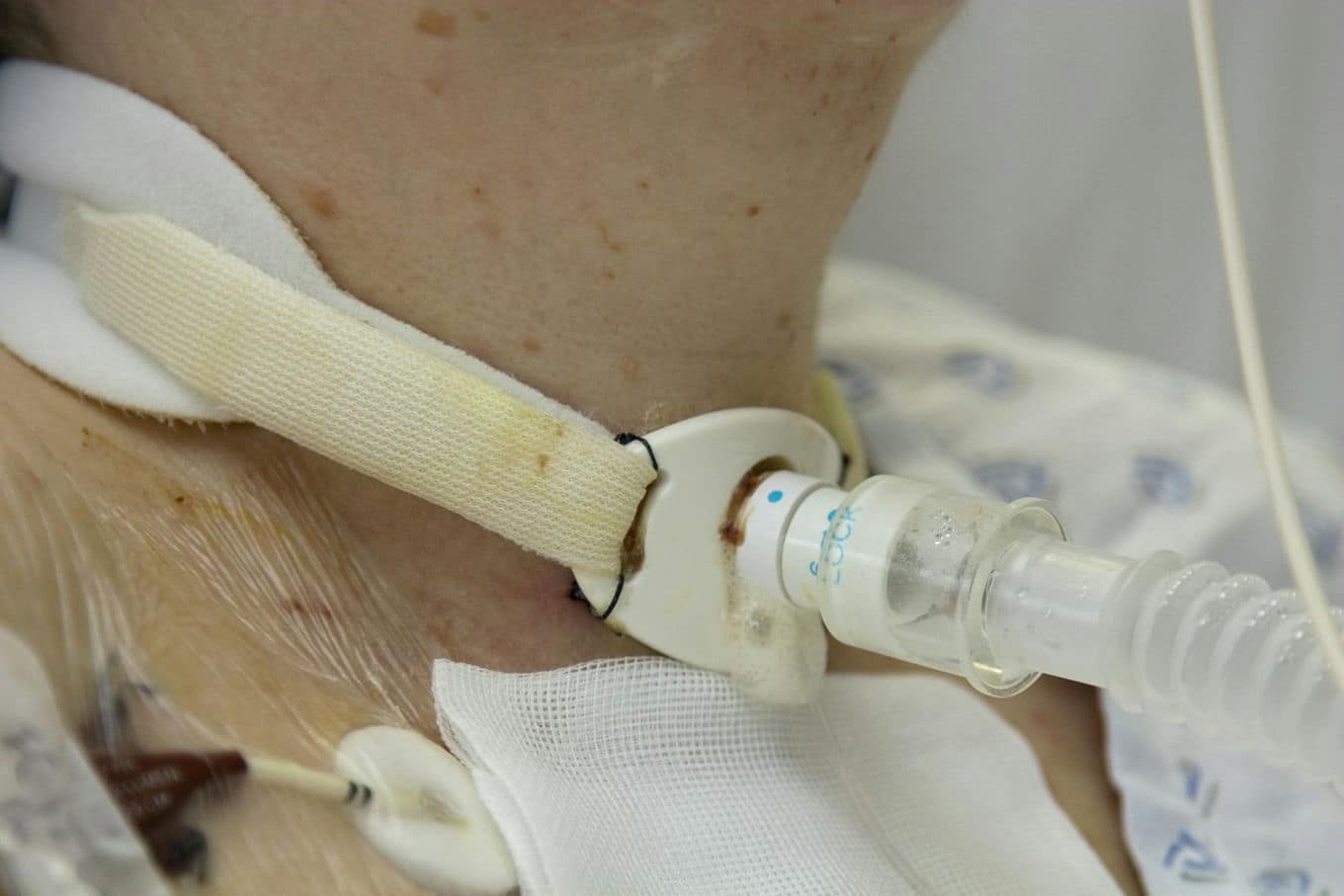 Silikon kontra polichlorek winylu - który materiał na rurki tracheostomijne jest lepszy?